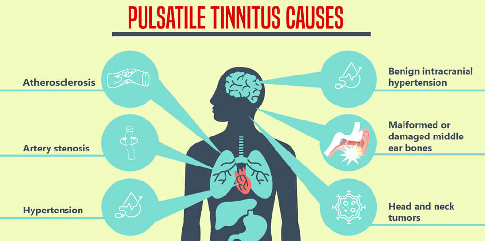 pulsatile tinnitus